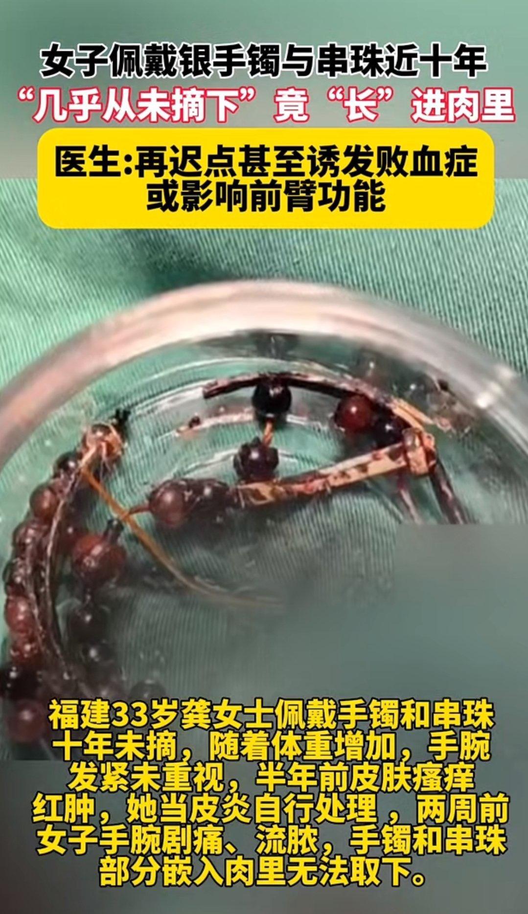 惊心！女子手镯十几年未摘，竟长进肉里

这世界总那么多莫名其妙且让人难以理解的事