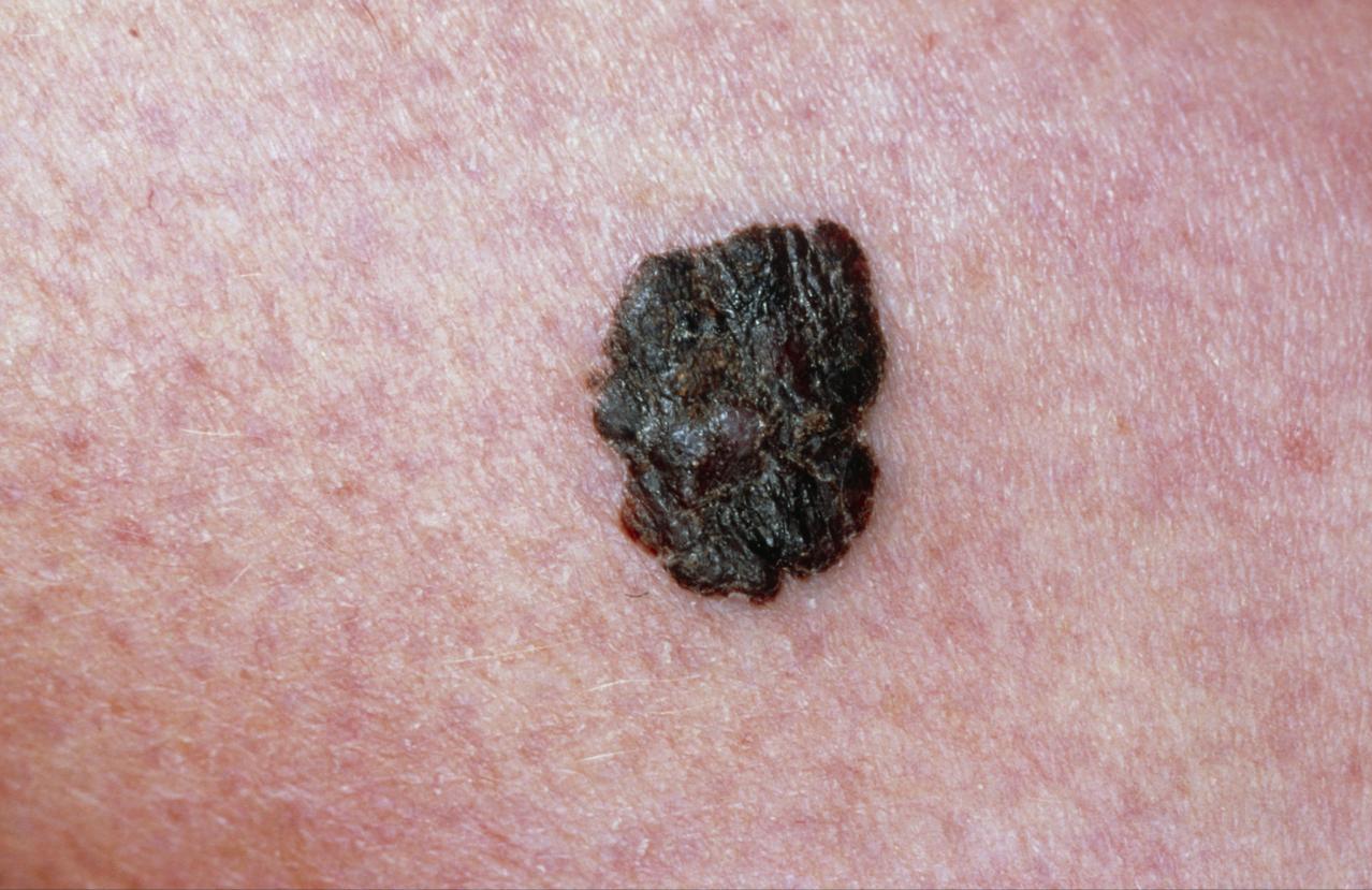 24岁抗癌小伙去世，他所患的黑色素瘤到底有多恐怖，发现即晚期
24 岁抗癌博主徐