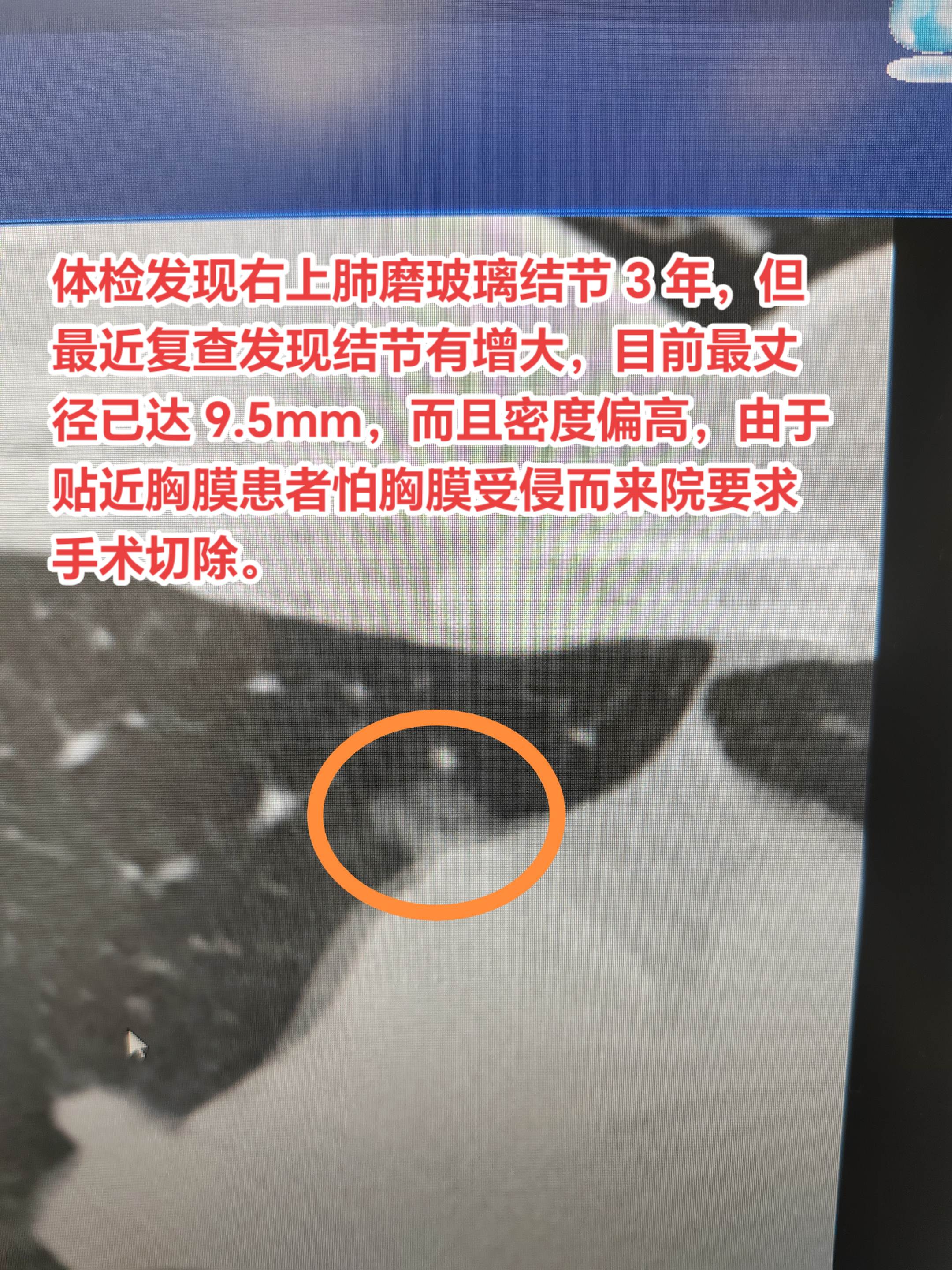 生长快的磨玻璃结节还是需要积极处理的。体检发现右上肺磨玻璃结节 3 年...