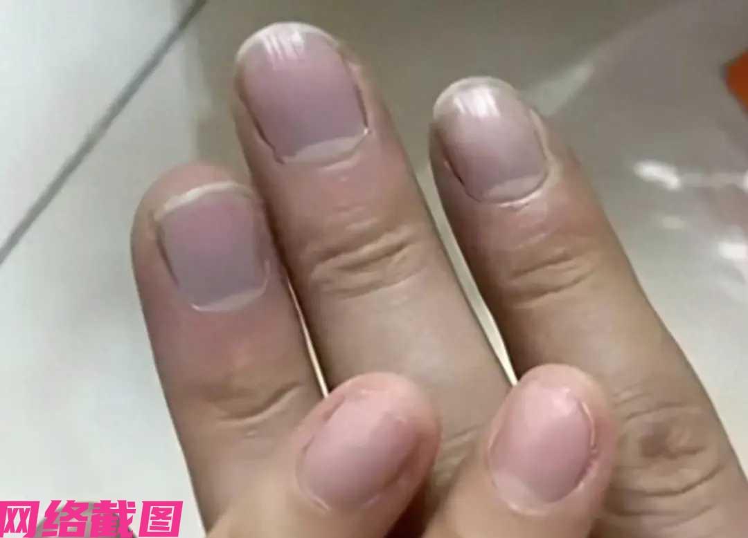 浙江某女子在一次偶然眼光里，看见自己老公的手指发紫，看上去还挺严重，忙和老公说去
