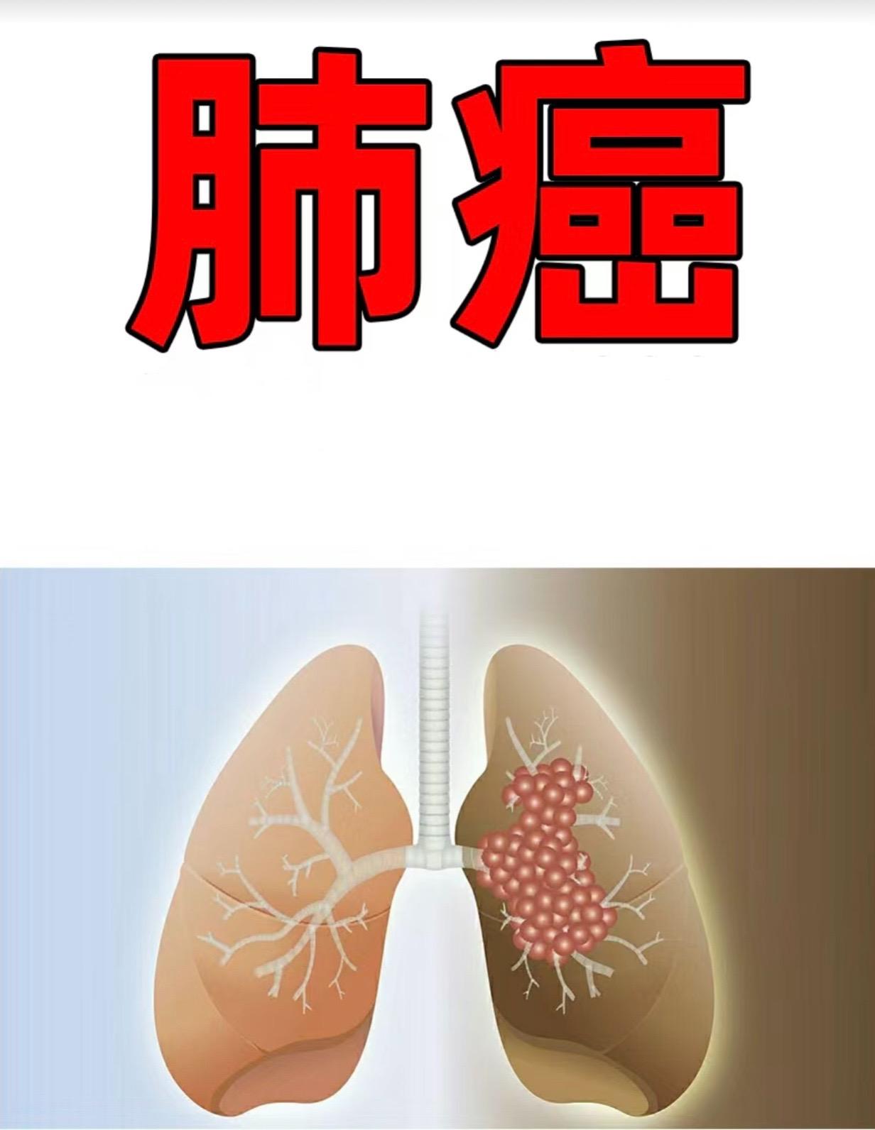 肺癌的种类 常见的病理类型。