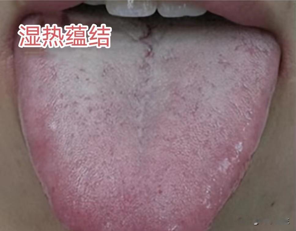 舌头出现裂纹怎么回事，今天教你一步分辨四种裂纹舌

1. 舌质偏红，裂纹在舌根处