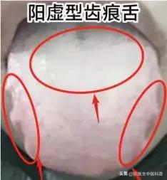 脾虚齿痕舌+舌中裂！纯纯脾虚湿盛别调错
 
宝子们！陈大夫教你辨舌象💡
舌边一