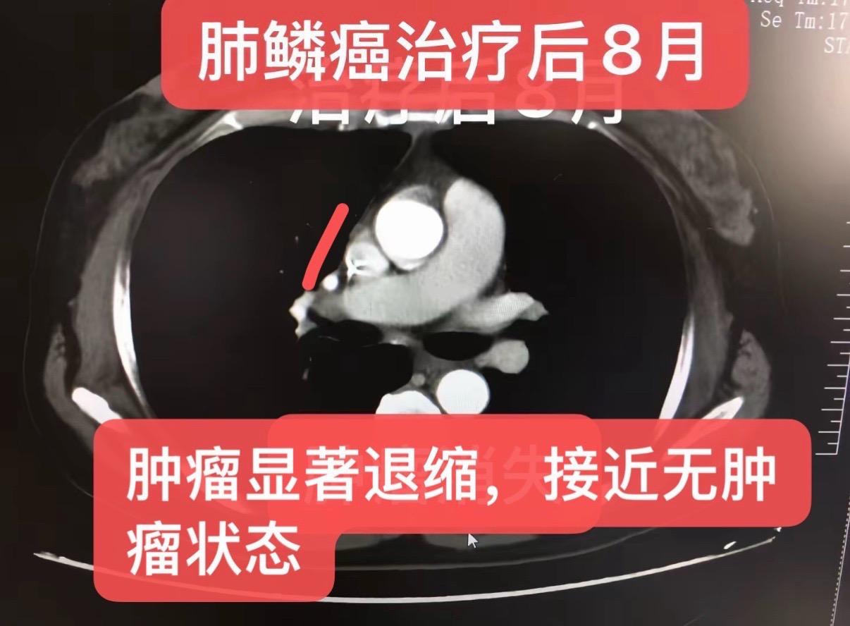 一例局部晚期肺鳞癌的治疗：个案分享。一例局部晚期肺鳞癌的新辅助治疗历程...