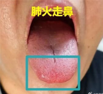 #中医##康尧小儿推拿# 老中医舌诊口诀（细品每一句）舌为心之苗，脾之外候，苔由