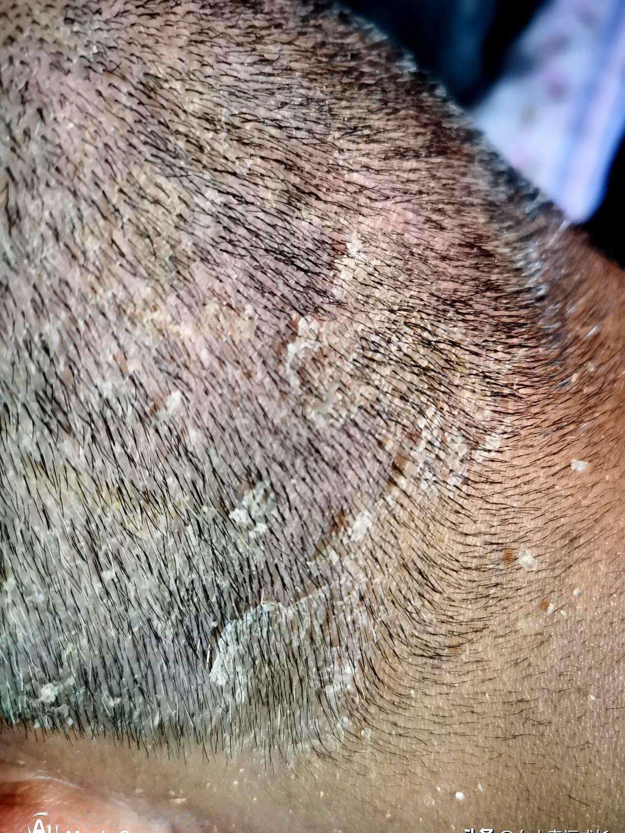 染发30年，头皮屑厚到下雪！
 
头皮一抠就掉渣，白衬衫领子永远洗不净。医生一句