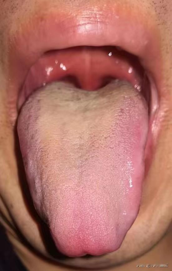 朋友，这都火眉毛了，还不在意，你看你那舌头红的

主诉：失眠、头晕头痛、烦躁、爱