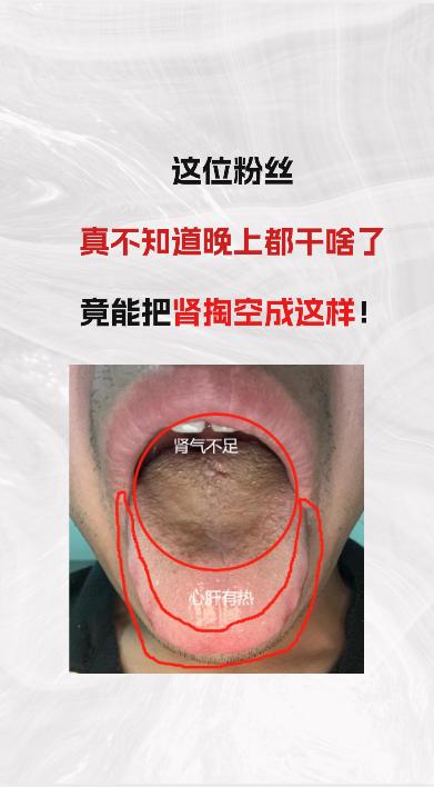 这位粉丝，都不知道他晚上都干啥了，竟把肾掏空成这样子