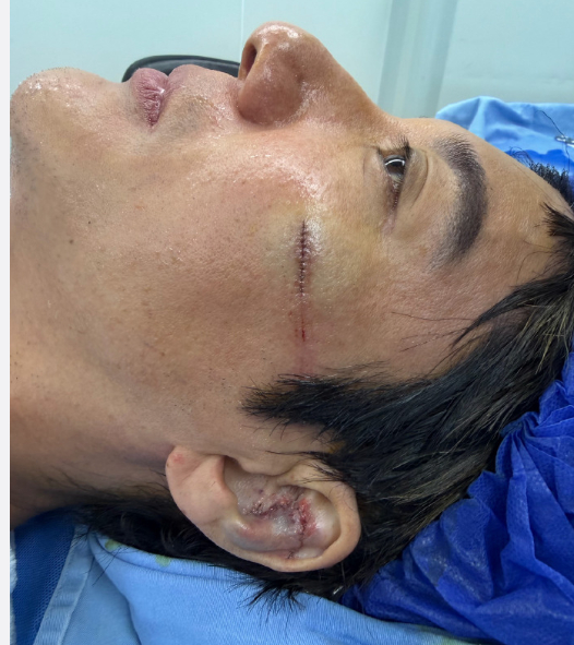 王力宏事故责任人员被调查王力宏外耳软骨撞碎了 看着真的揪心，演出时被钢丝绊倒狠狠
