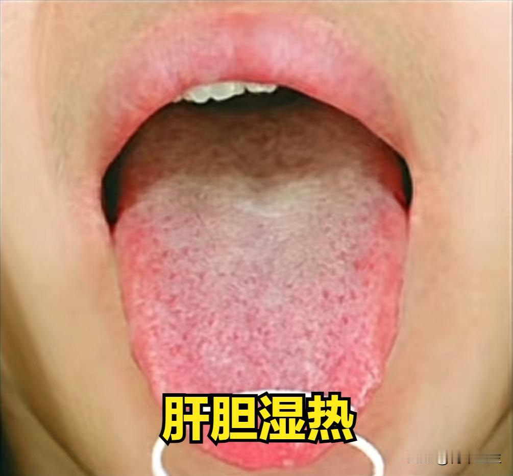 肝病四大证型，一病一方，从病根上调理

1. 肝胆湿热
症状：胸胁胀痛，有灼热的