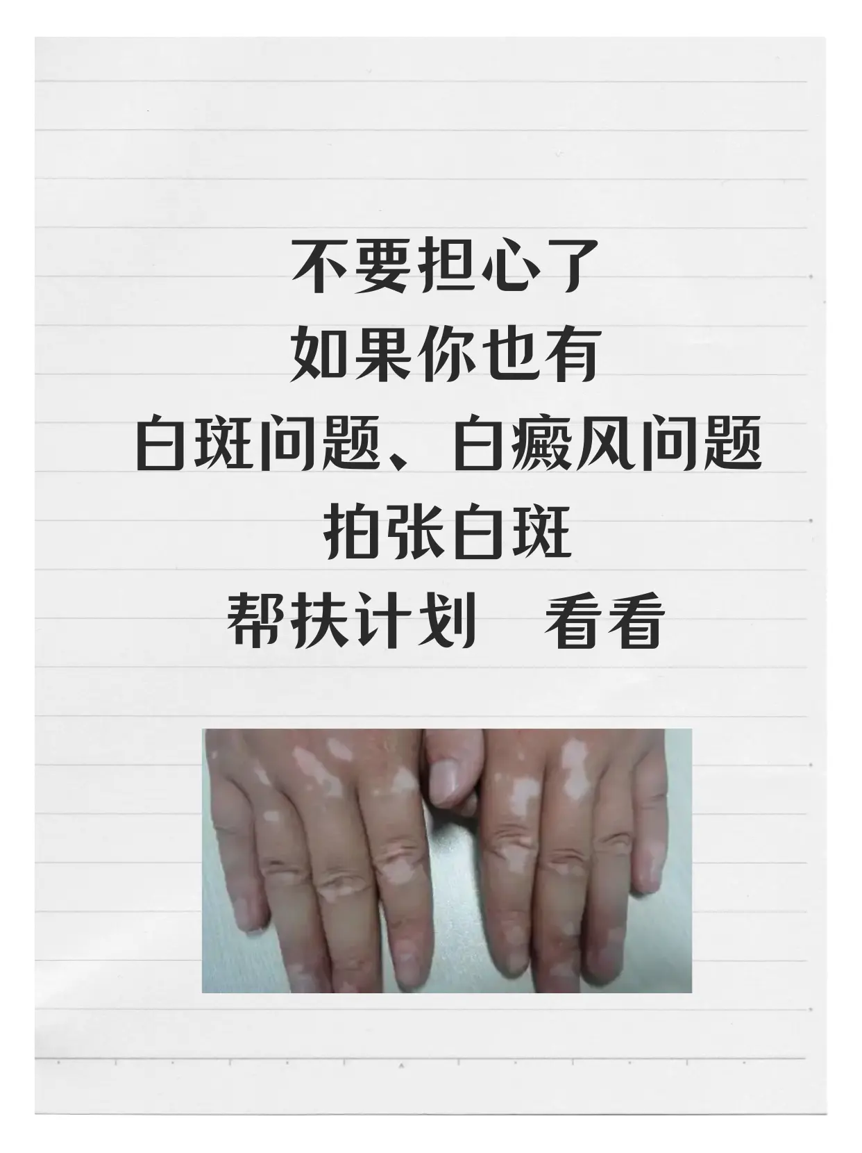 白癜风 白斑 皮肤健康