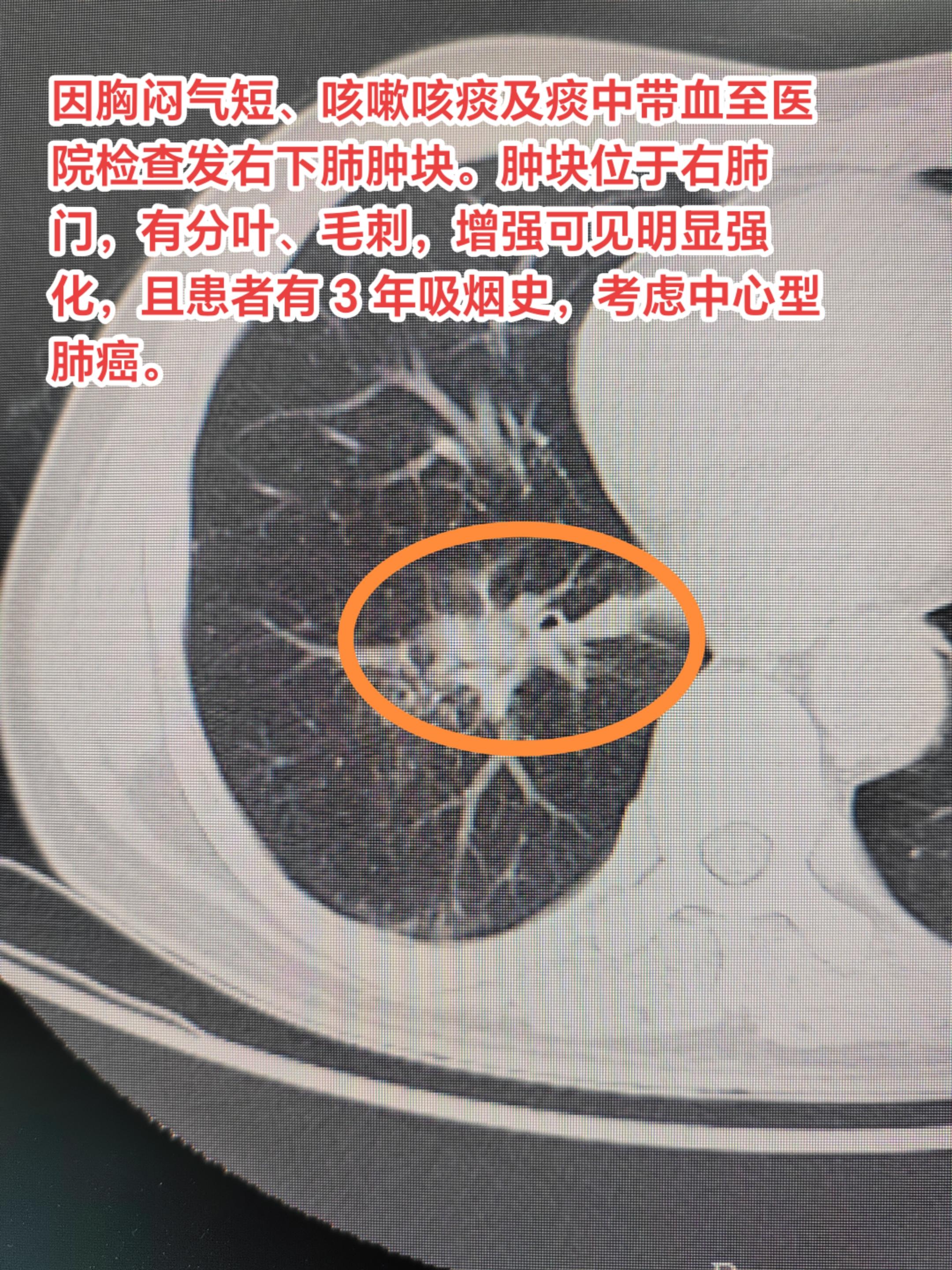 肺鳞癌有哪些症状？常见病因是什么？因胸闷气短、咳嗽咳痰及痰中带血至医院...