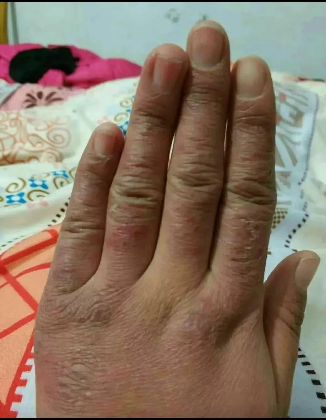 我红肿瘙痒的冻疮终于治愈了，我冻疮有二十年了，以前一到冬天，手脚又红又肿还痒得要