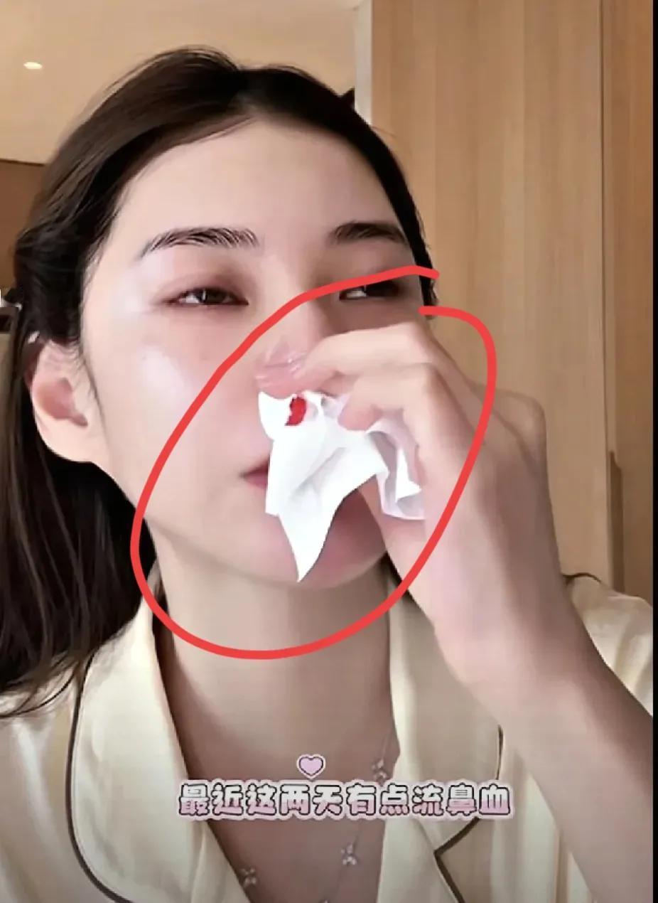 马筱梅和大曲线同病相怜啊！都不适合北京的天气，开始过敏流鼻血，大S很早就透露自己