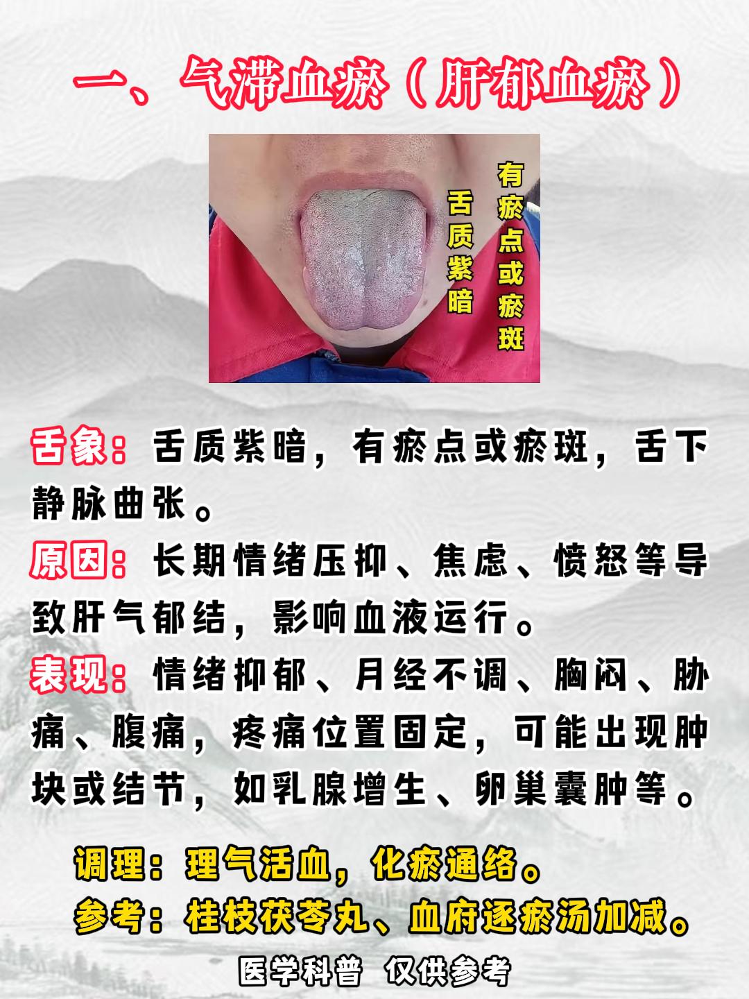 气滞血瘀、寒凝血瘀、热壅血瘀、气虚血瘀、阴虚血瘀你是哪种淤？
总结了中成药送给你