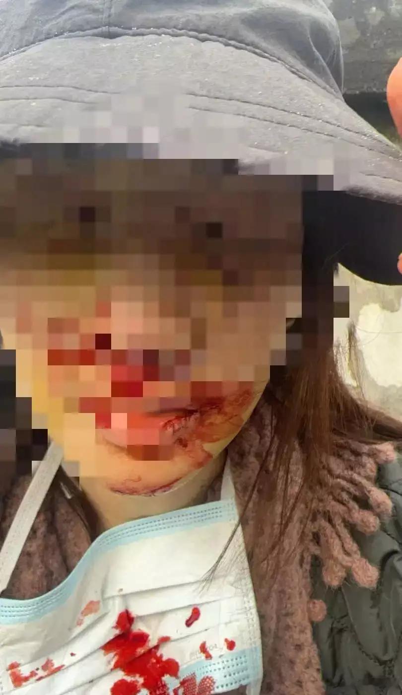 金晨自曝车祸事故现场照 