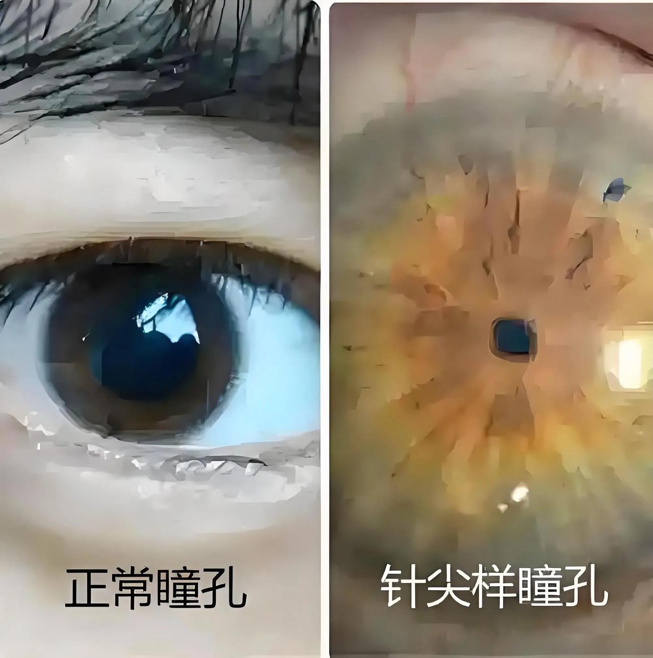 针尖样瞳孔！[黑脸]
虽有点吓人，但您想了解！

人的瞳孔是个圆圈，就像照相机的