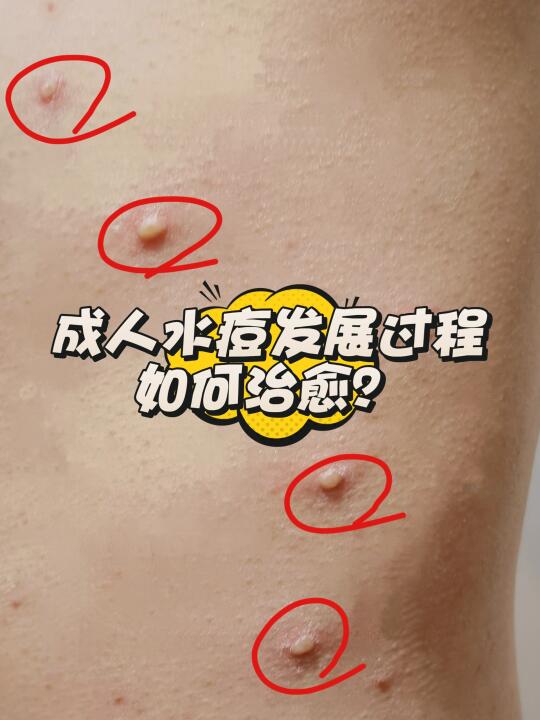 亲历分享！成人水痘发展过程及如何治愈