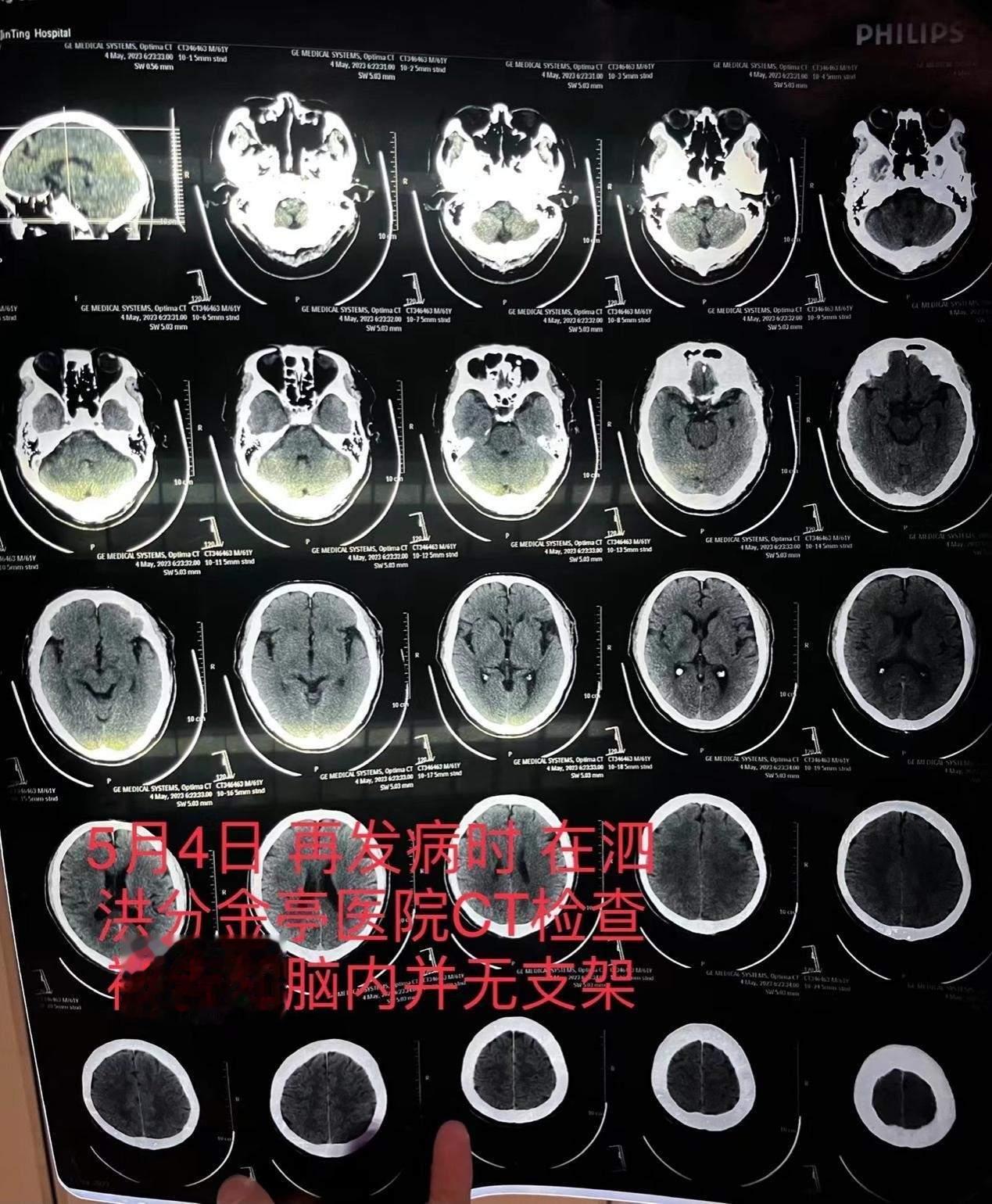 【“消失的脑血管支架”追踪：家属称已妥处，卫健部门未回应】江苏宿迁一位老人脑梗去