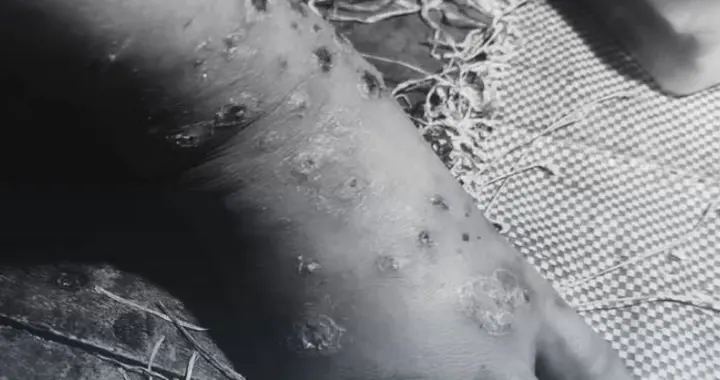 比冲突更可怕的“隐形杀手”！缅甸难民遭它“围攻”，已有人死亡