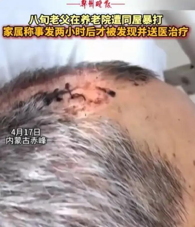 内蒙古赤峰，女子将丈夫送到养老院，几天后接丈夫，只见丈夫裤子直接裂开到裤裆，上衣