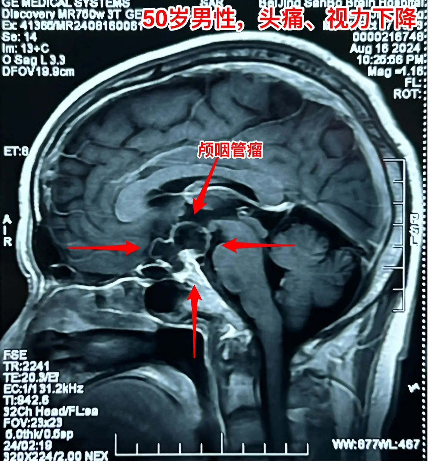 颅咽管瘤手术，出院3天就开车，合适吗？50岁的山东临沂男性，因头痛一年...
