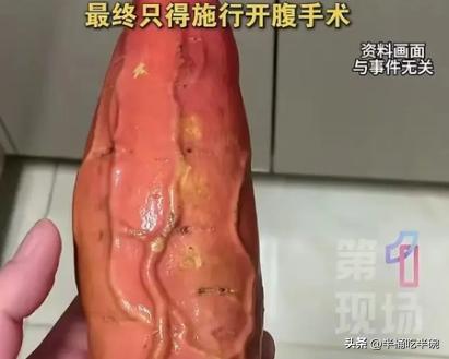 四川成都，61 岁的本地男子张某，将一根尺寸极大的红薯塞进体内，硬生生把自己送进