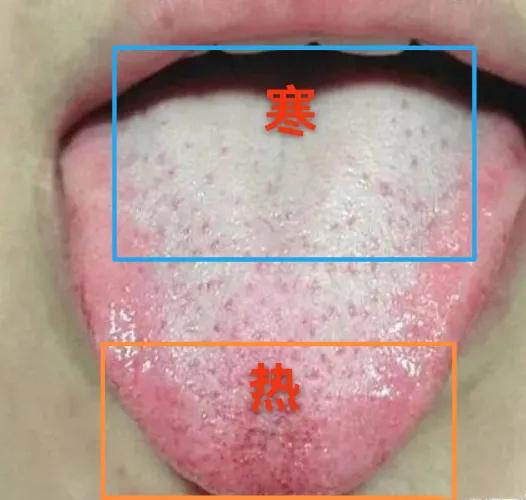 看这个舌象，典型的上热下寒！清火怕冷，进补易上火
患者主诉：肾虚，功能不佳，时间