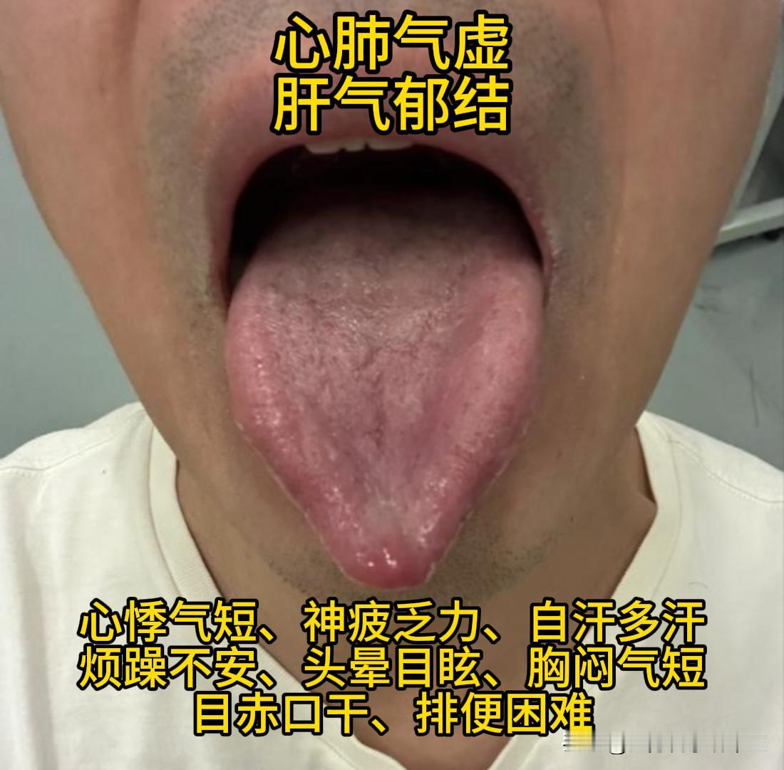 今天有空，可以帮大家看看舌象，10分钟内出结果！！！

1、心肺气虚，肝气郁结