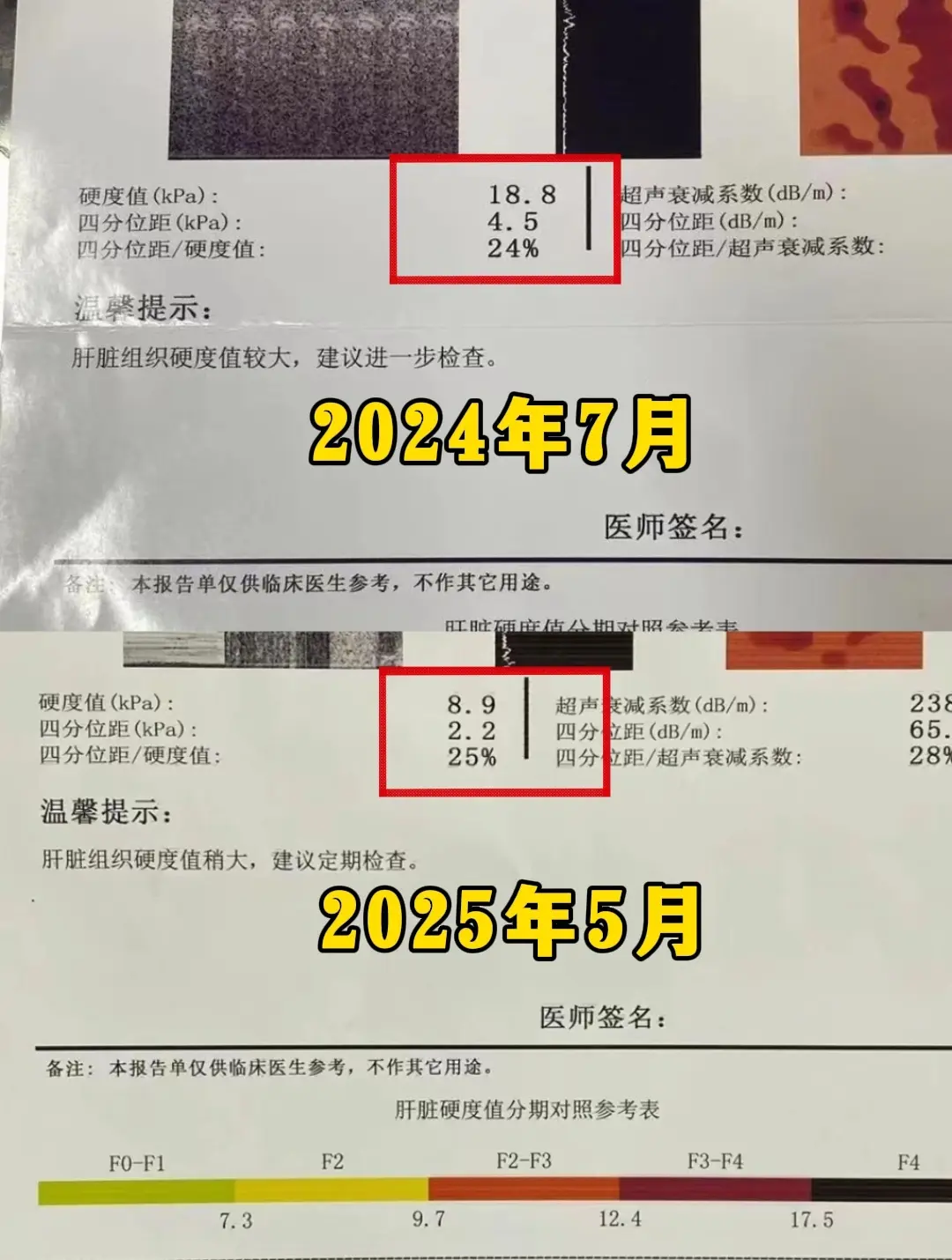 这是我的一位老病号了，乙肝肝硬化3年，没有出现肝腹水、肝性脑病、呕血便...