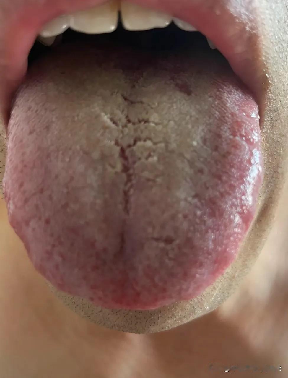健脾补脾之前，一定要先把舌苔，处理干净[抠鼻]！

来看这位患者，主诉容易乏累，