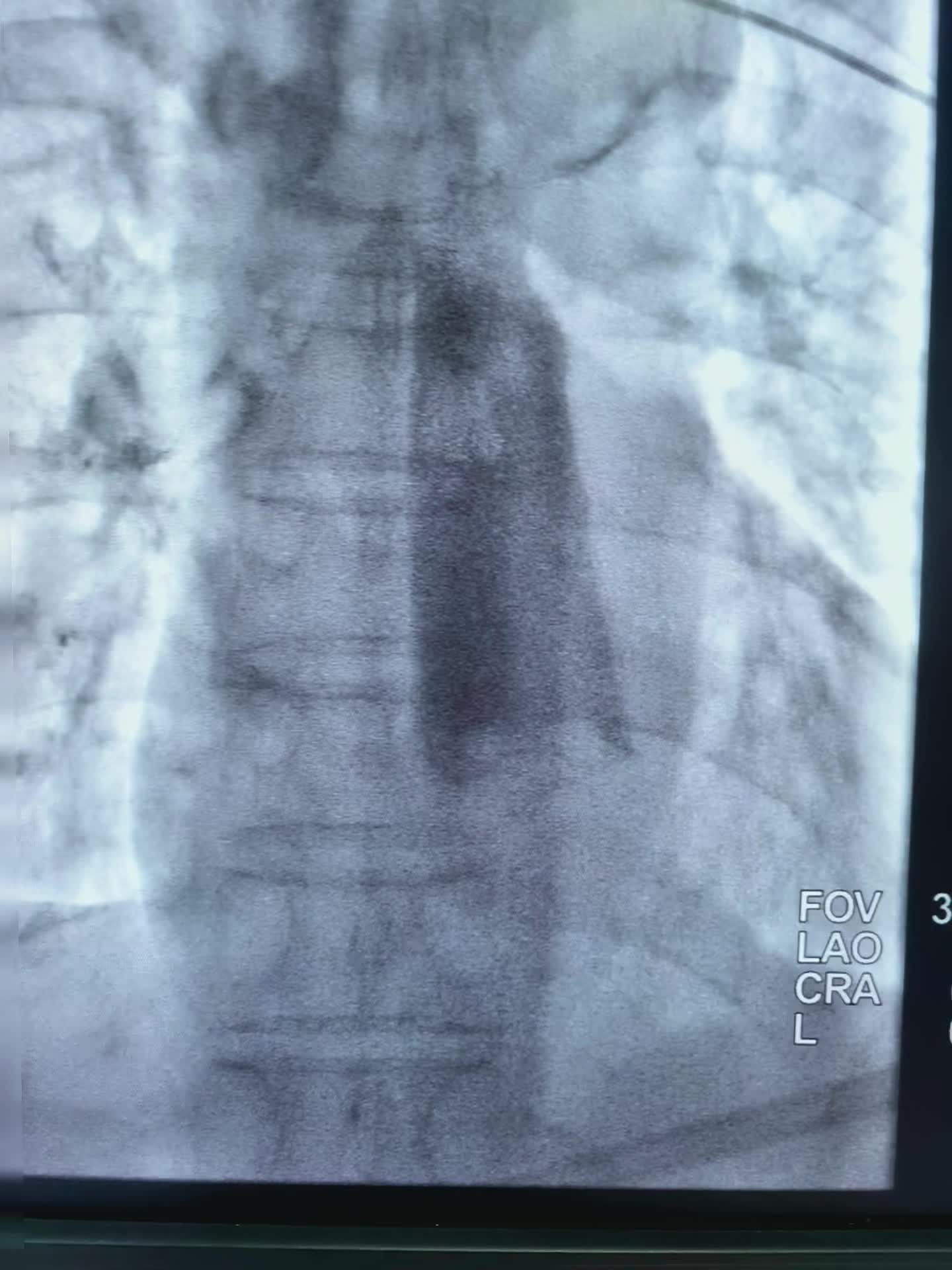 上午第一台78岁老年男性贲门癌患者，突发食管梗阻不能进食水，行球囊扩张...