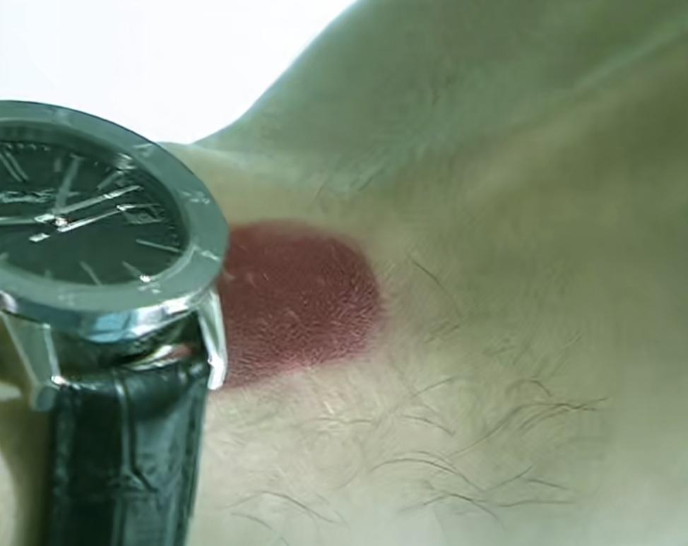 女董事长一抬头
震惊的发现
男医生手腕上的胎记 ，竟然和自己失散三十年的儿子的胎