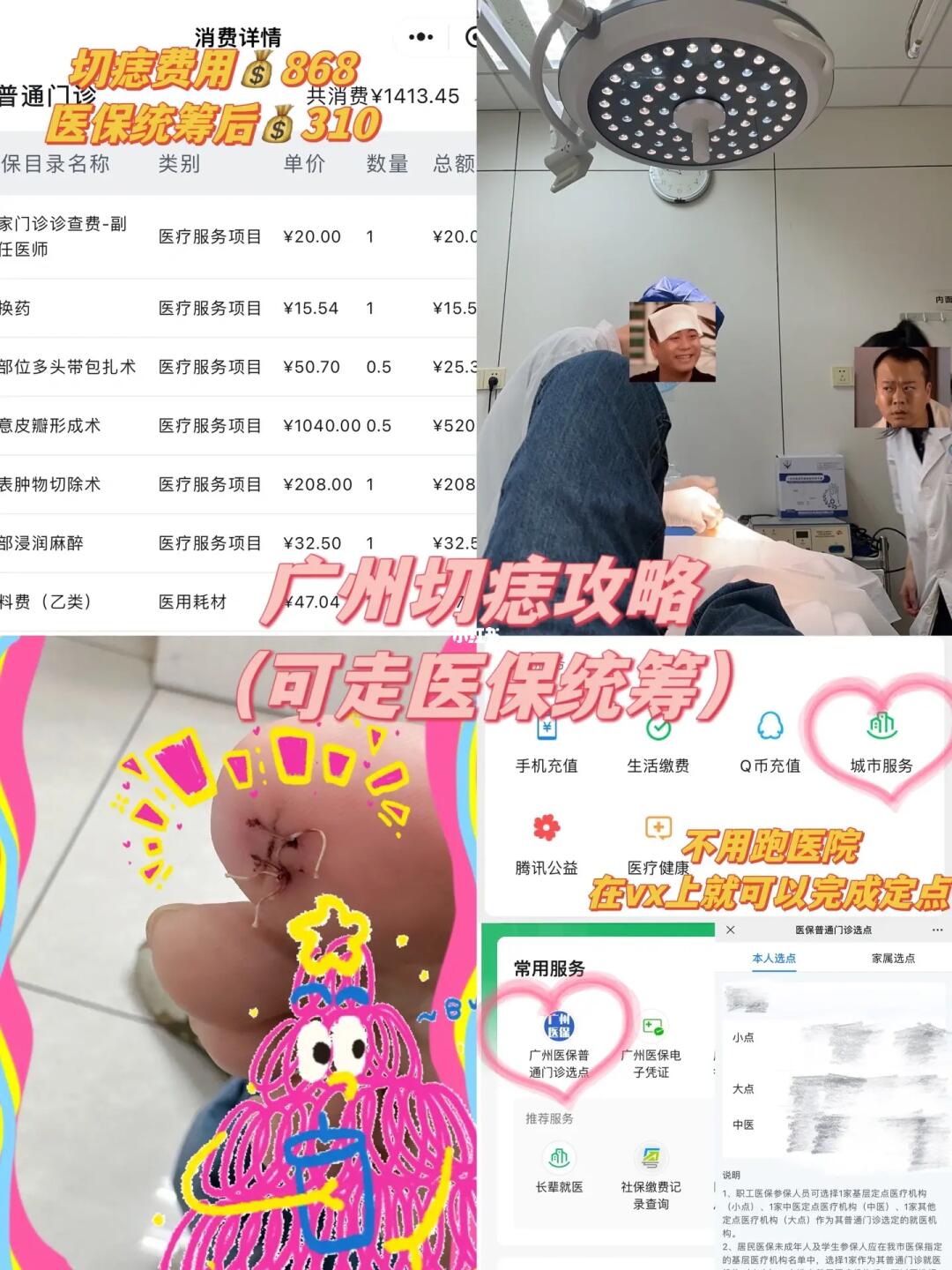 广州脚底切痣攻略🤣（亲测可走医保统筹）