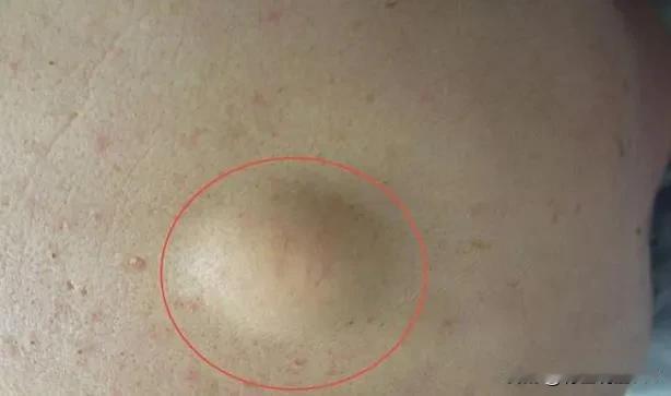 脂肪瘤：成因、分类与中医治疗！

在日常生活中，我们经常听到脂肪瘤这个词，但您真