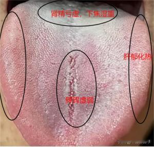 肾精亏虚，吃五子衍宗丸没有用，看完这个舌头你就明白了
主诉：结果以后发现自己不仅