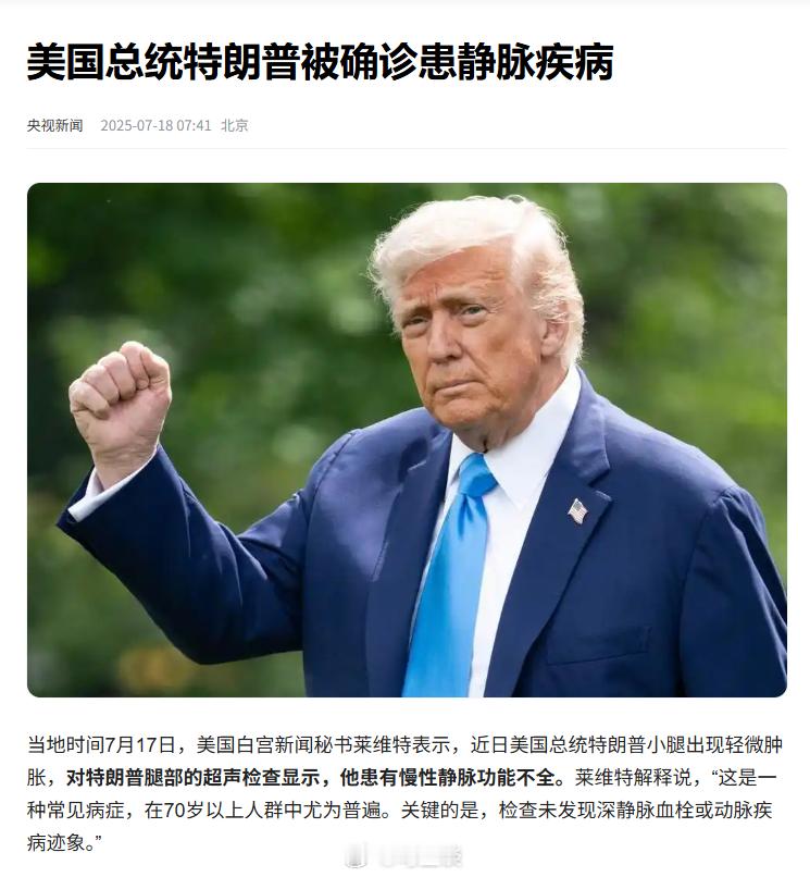 美国总统特朗普手部淤青，脚踝肿胀，被确诊患静脉疾病。回旋镖，4年前一直说拜登，现