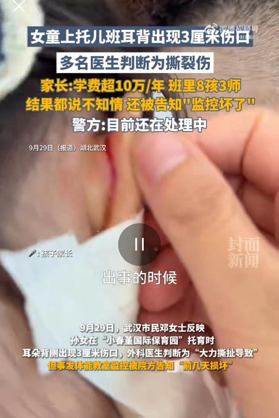 武汉一所国际保育园，每年学费高达10万元。在该园就读的一名女童，耳后突然出现一道