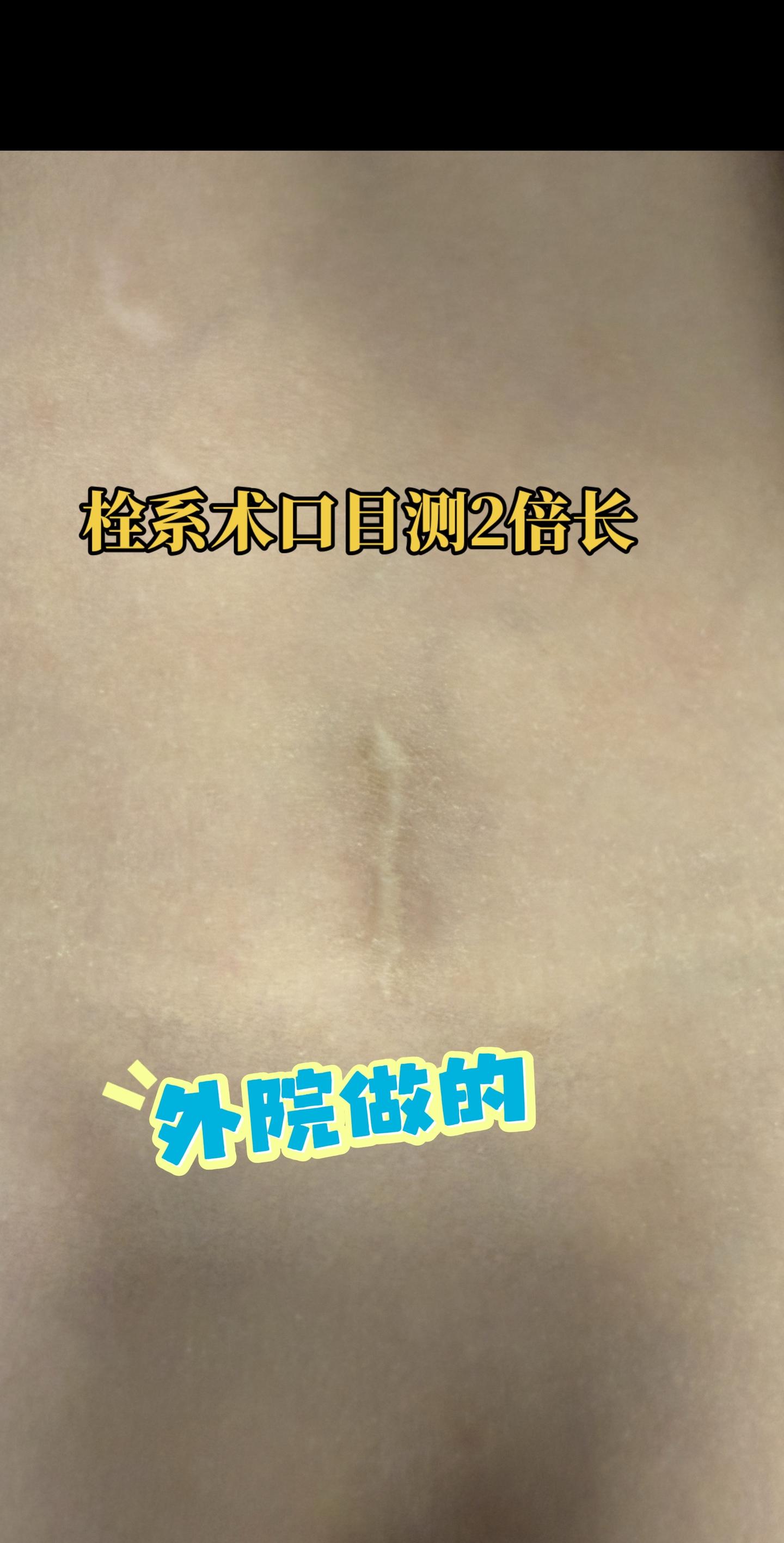脊髓栓系术口对比。外院做的小儿栓系术口，目测是我的2倍。