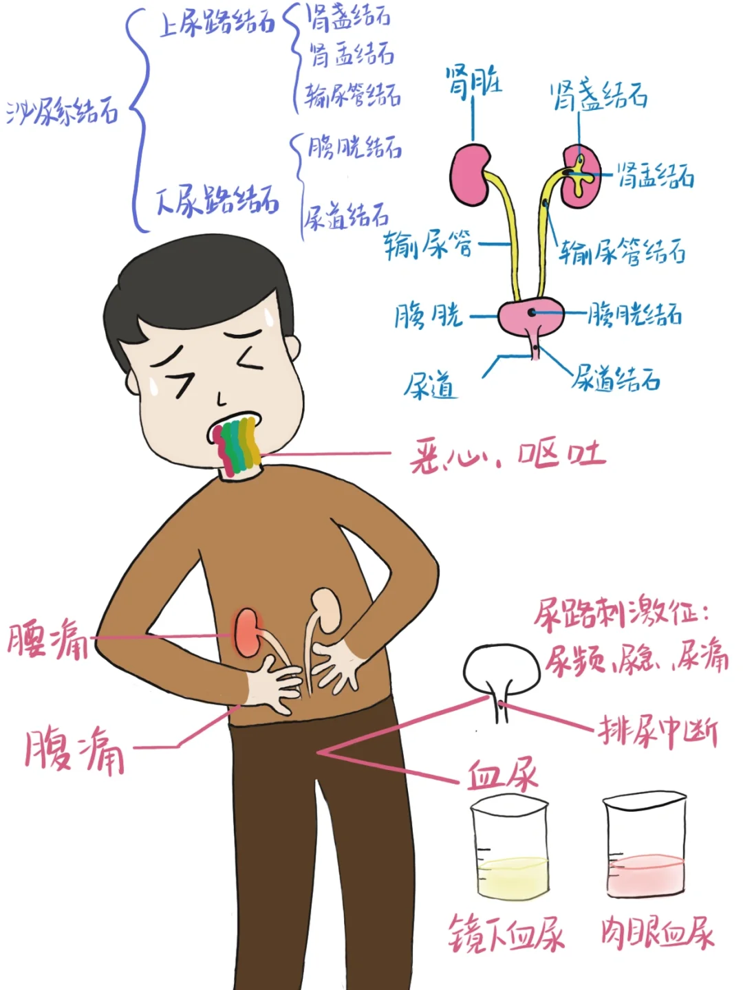 医学生笔记📒｜泌尿系结石🧐