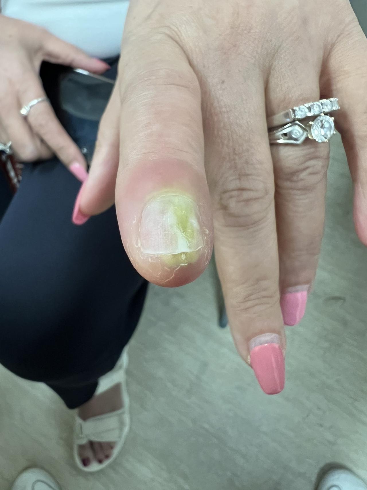 这位患者做美甲感染了，甲下积脓了
