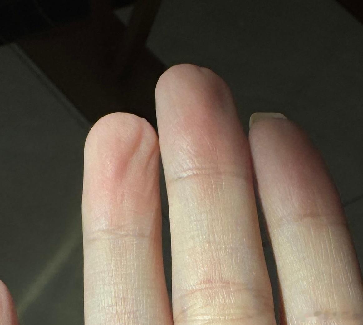 手相一则：中指和无名指指肚子如果某一段时间内皱皱巴巴的，且保持了3个月以上一是要