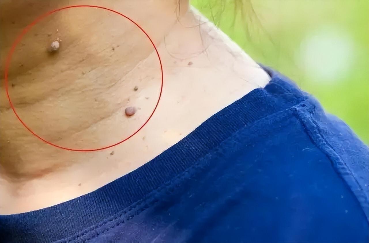 如果感染这几个病毒，说明免疫力已经很低下了，一定要注意！
1、带状疱疹病毒，这是