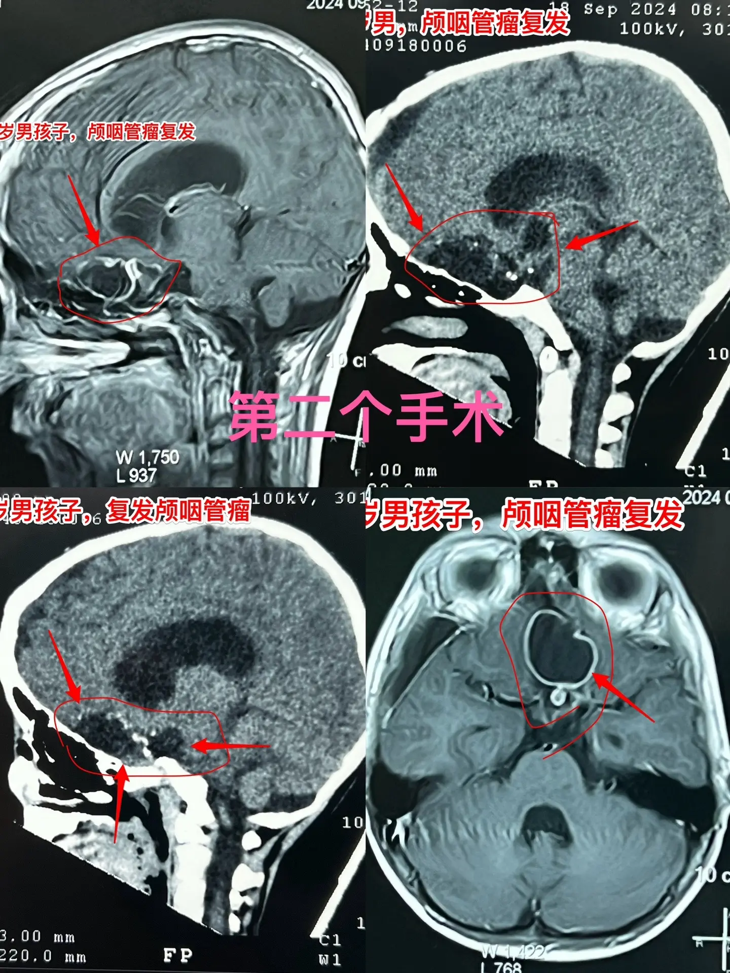 9月22日周日的四个手术。国庆节前一周时间，等着作手术的病人太多了，手...