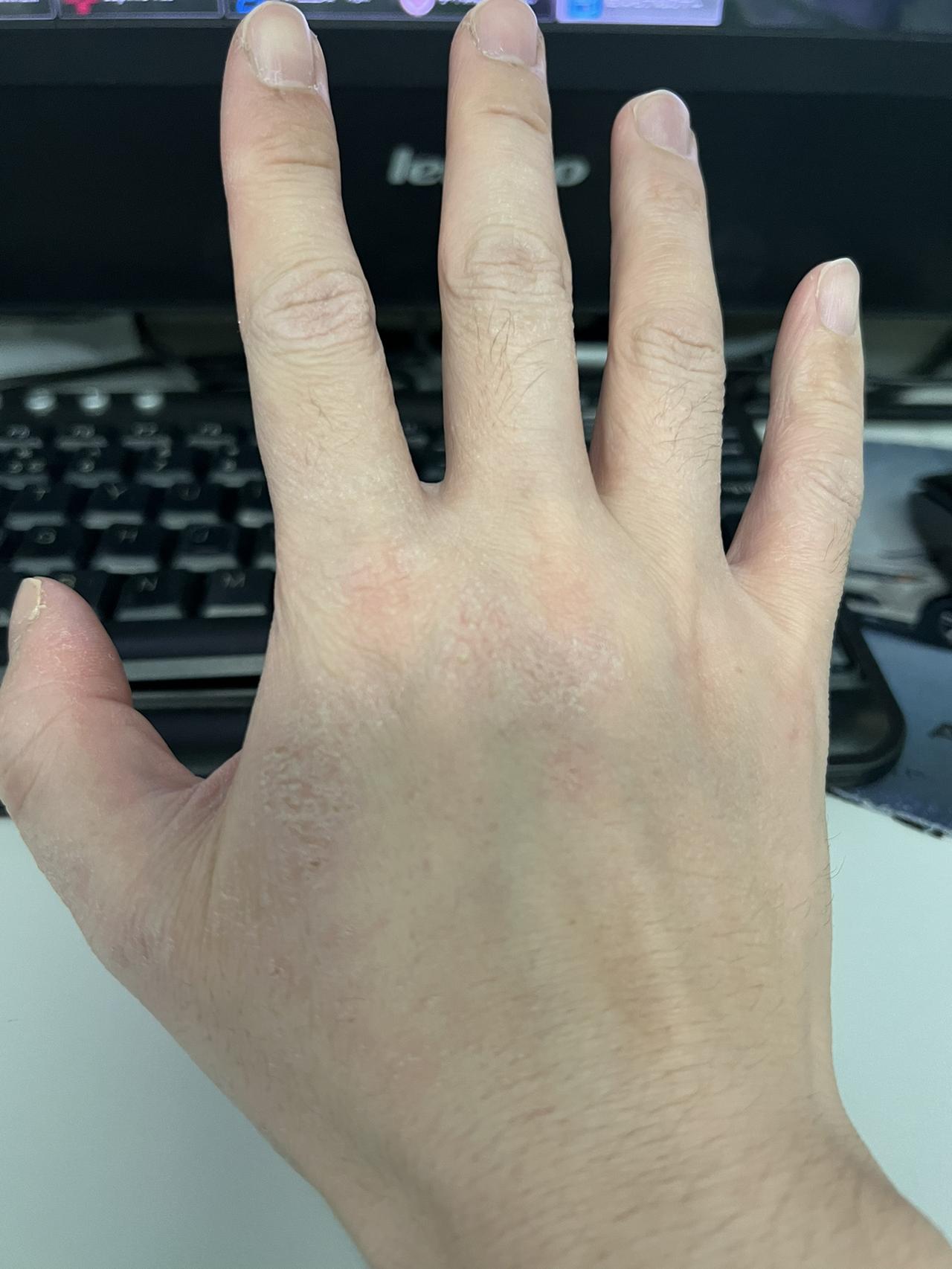 每天频繁的做手术，洗手，手上的皮脂膜都被洗掉了，护手霜必须使用#医学科普 #医学