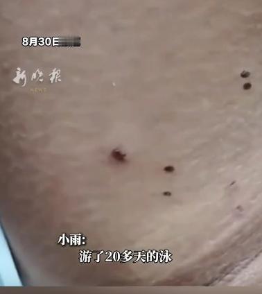 太吓人！天天游泳减肥，女孩身上疯狂冒出 20 多个疙瘩。

最开始，只是胳膊腋下
