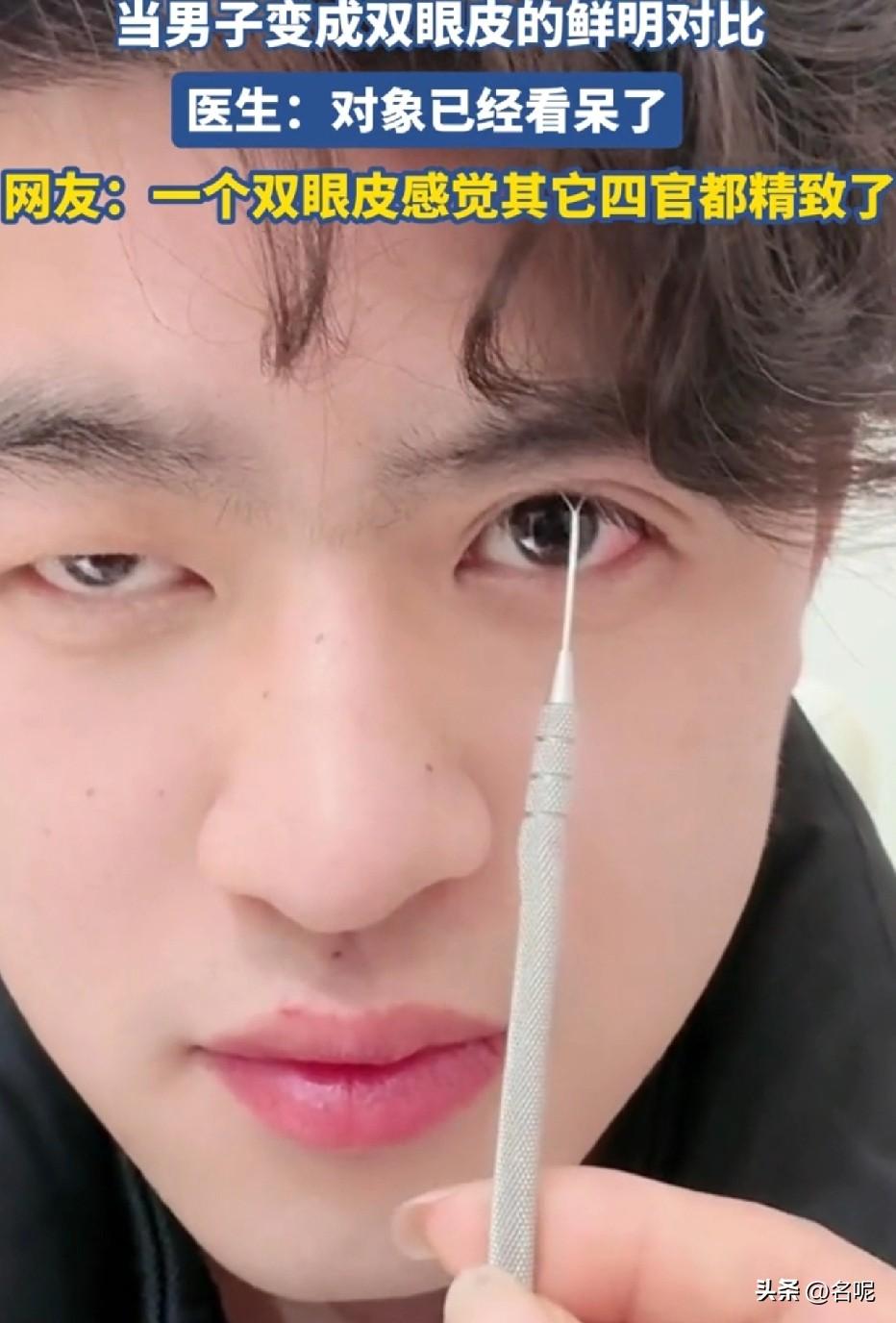 终于明白为什么那么多人去做双眼皮了，真的是为了让自己更好看。

一男子晒单眼皮跟