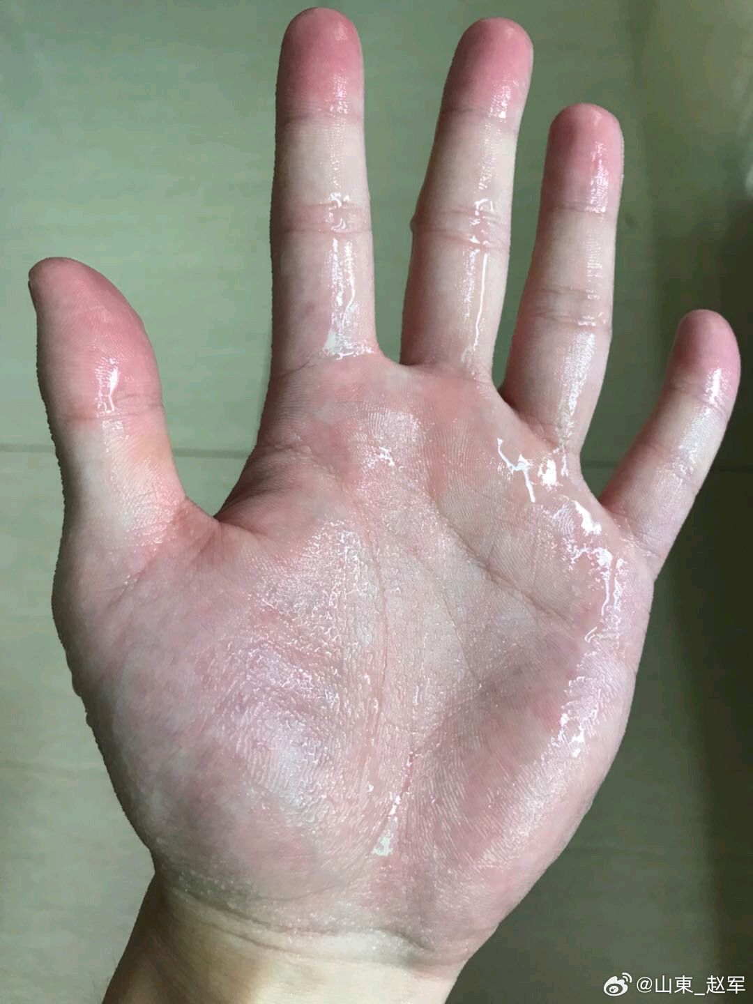 葛矾汤（葛根+白矾外洗方）完整客观解读，分优势、适用、局限、禁忌、实操提醒一、原