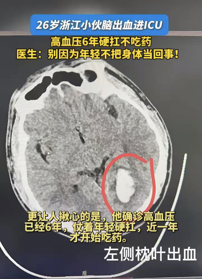26岁小伙进了ICU，原因让人后怕!浙江一名酒店员工常年上夜班，突然右眼看不清，