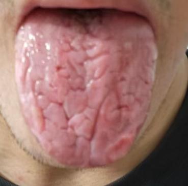 中医视角解读腰突：分清证型再辨证调理







对于腰间盘突出很多人并不陌生
